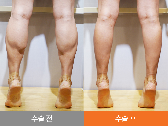 하피스 종아리 성형