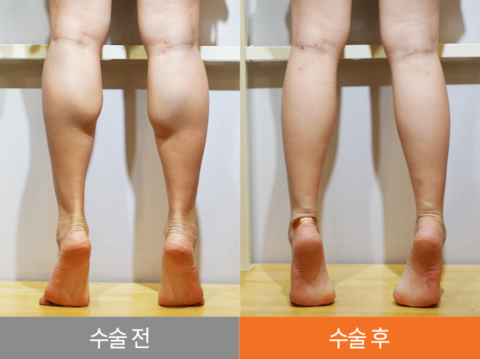 하피스 종아리 성형